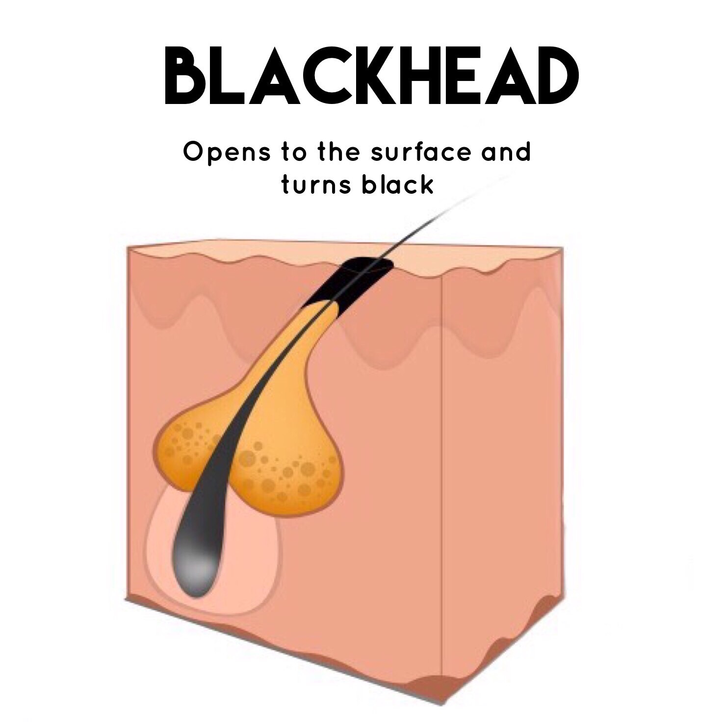 Blackhead