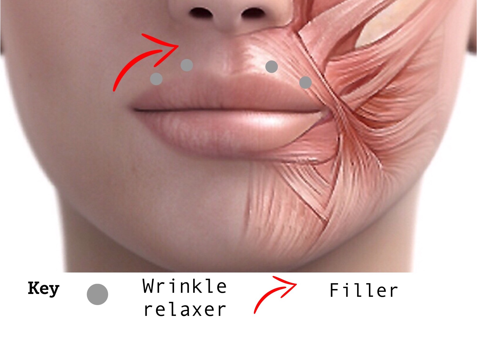 Injection Sites Upper Lip Lines