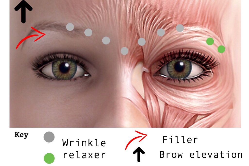 Non surgical brow lift jeunesse medspa 
